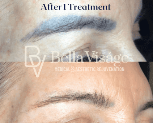 Microblading Removal After 1 Treatment_2-min