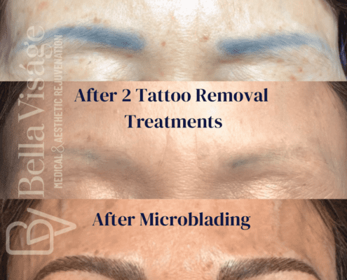 MicrobladingRemovalBefore-6-min