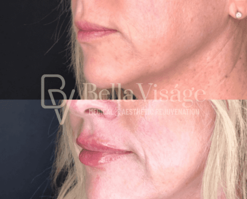 lipfiller-march2025-1-min