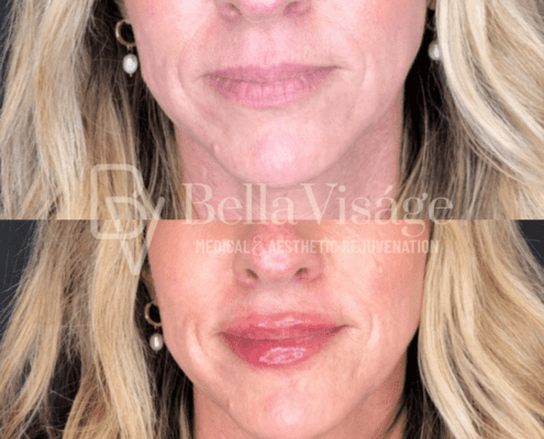lipfiller-march2025-2-min