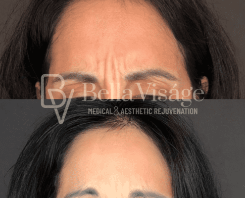 neurtoxin-bella-march2025-1-min