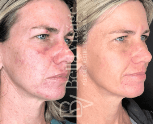 smoothglo-beforeafter1-min