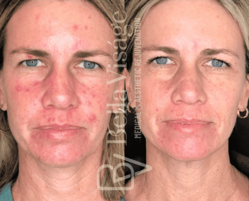 smoothglo-beforeafter2-min