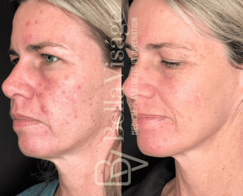 smoothglo-beforeafter3-min