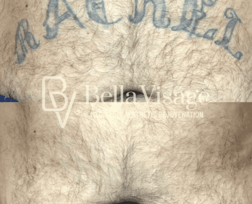 tattooremoval-march2025-2-min