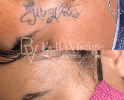 tattooremoval-march2025-3-min
