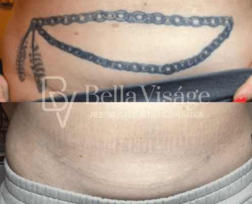tattooremoval-march2025-4-min