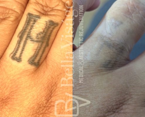 tattooremoval-march2025-5