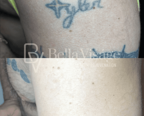 tattooremoval-march2025-min