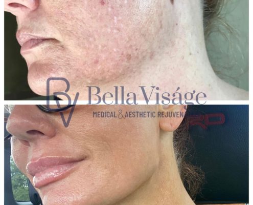 BV-Sculptra-BA-2