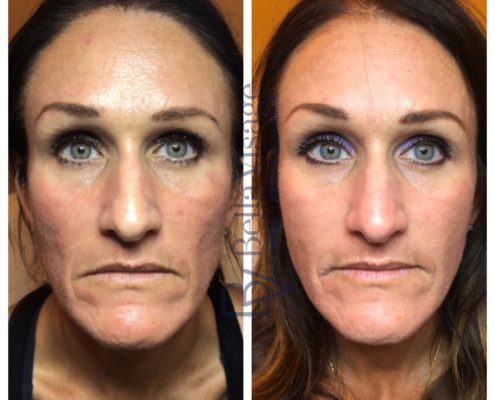BV-Sculptra-BA-3
