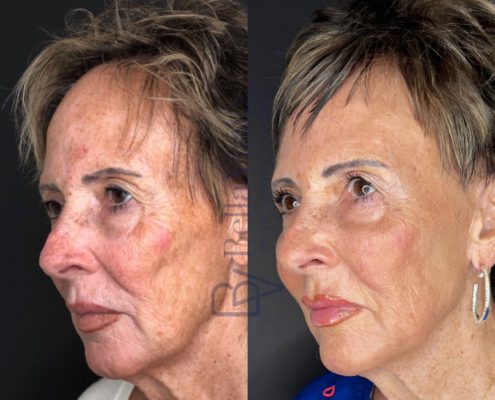 BV-Sculptra-BA-4