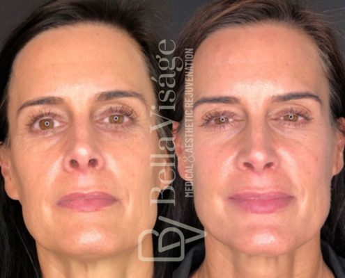 BV-Sculptra-BA-5
