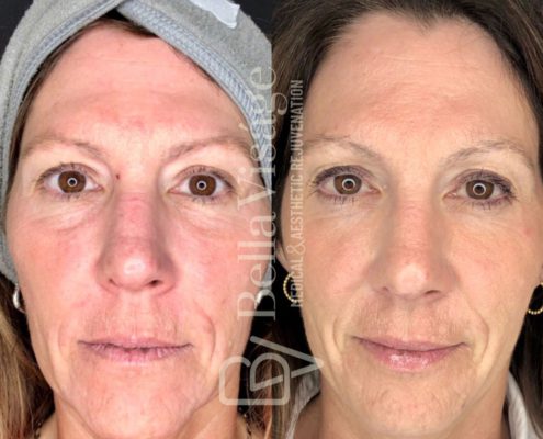 BV-Sculptra-BA-6