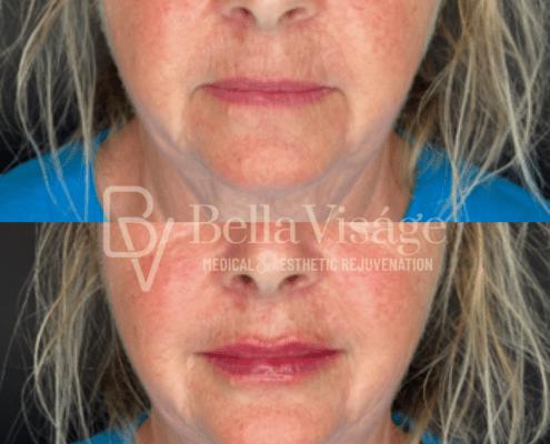 bella-face-filler-ba-1