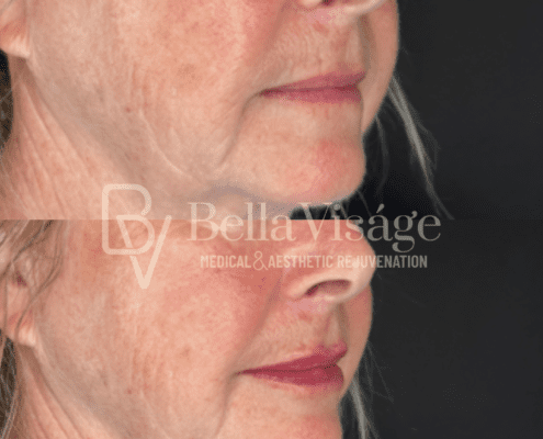 bella-face-filler-ba-2
