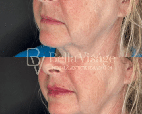 bella-face-filler-ba-3