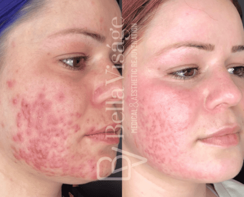 carbonlaserpeel-bella-ba1-min