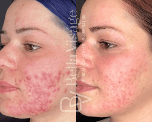 carbonlaserpeel-bella-ba2-min