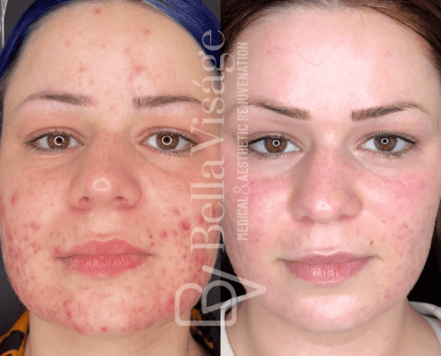 carbonlaserpeel-bella-ba3-min