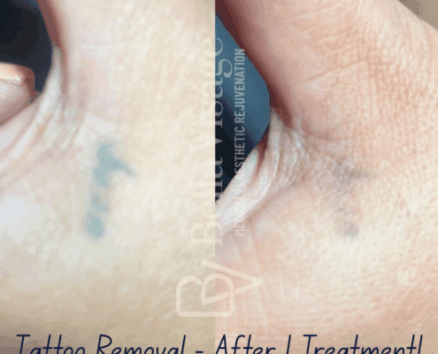 tattooremoval-june2025-1-min