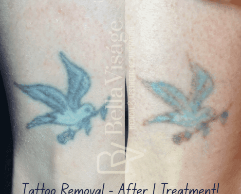 tattooremoval-june2025-2-min
