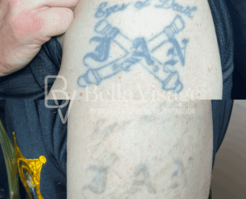 tattooremoval-june2025-3-min