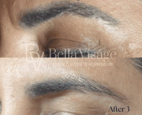 Cosmetic Tattoo Removal - After 1 Treatment!-min