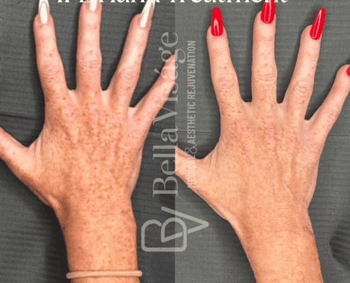 IPL Photofacial-july2025-2-min