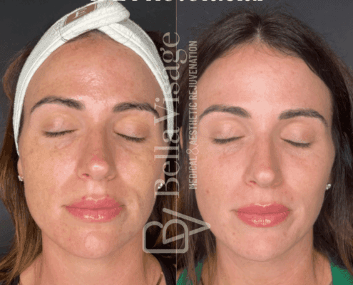 IPL Photofacial-july2025-3-min