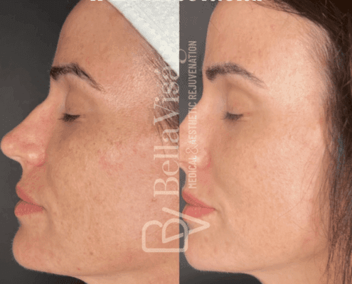 IPL Photofacial-july2025-4-min