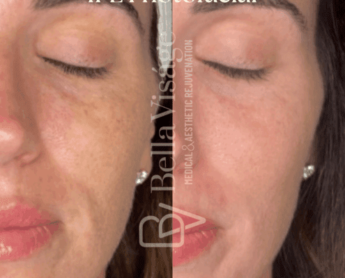 IPL Photofacial-july2025-5-min
