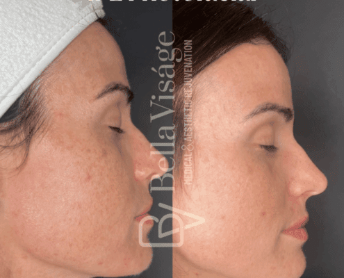 IPL Photofacial-july2025-6-min