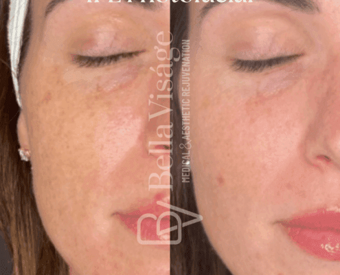 IPL Photofacial-july2025-7-min