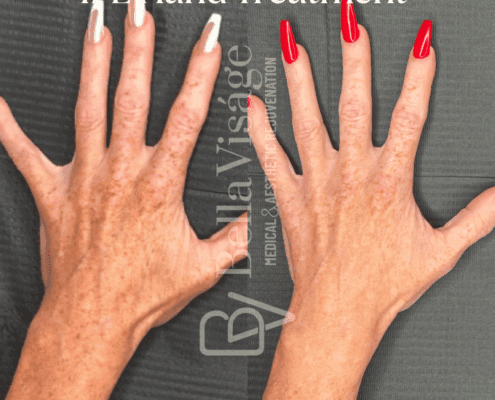 IPL Photofacial-july2025-min