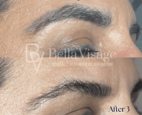 TCosmetic attoo Removal - After 1 Treatment!-min