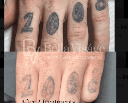 Tattoo Removal - After 1 Treatment!.png (1)3-min