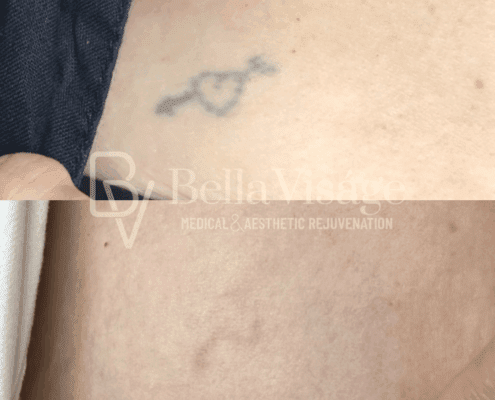 Tattoo Removal - After 1 Treatment!.png-min