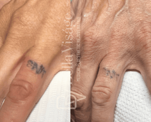 Tattoo Removal - After 1 Treatment!2.png (1)-min