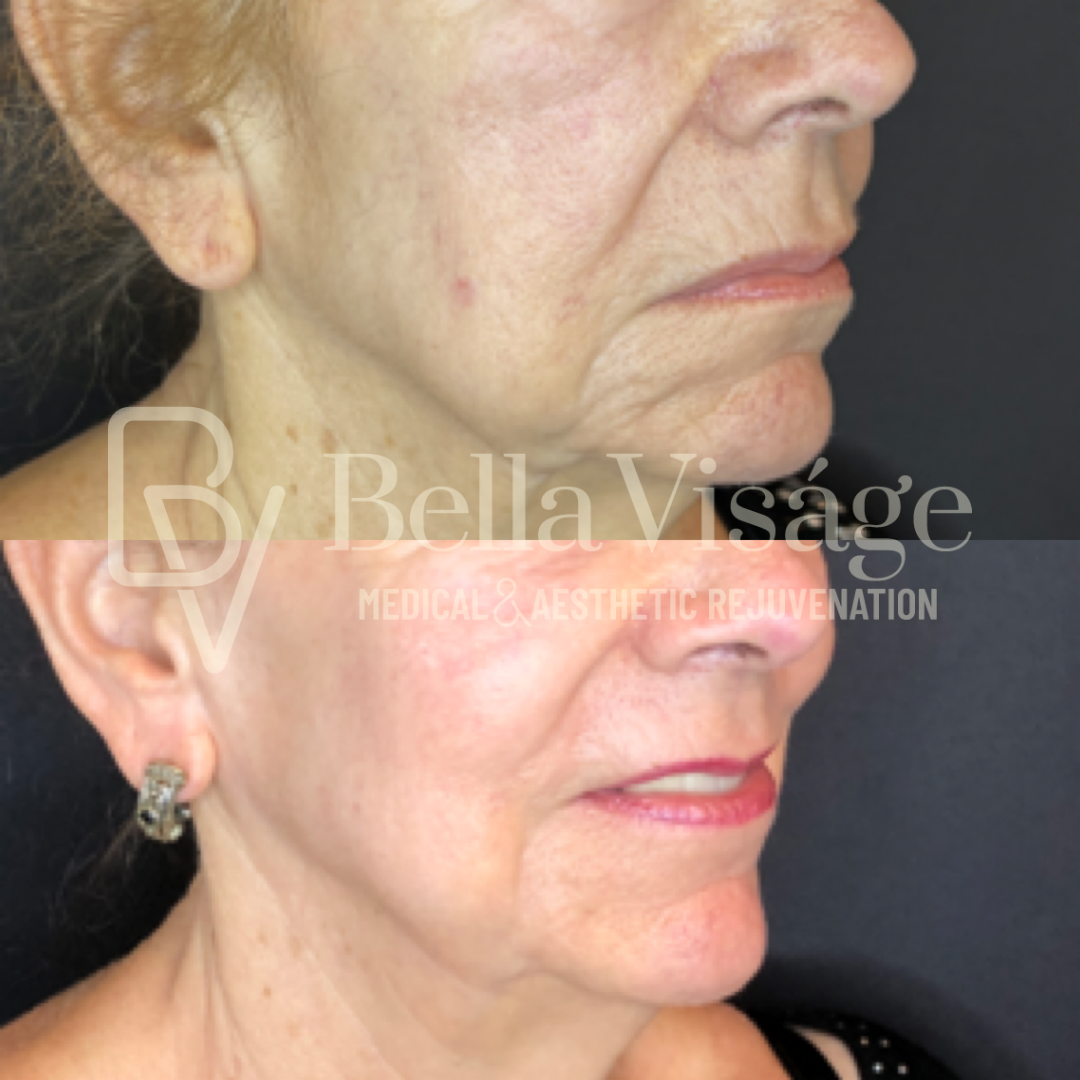 bella-helix-ba-9 Tattoo removal in Lakeland before and after