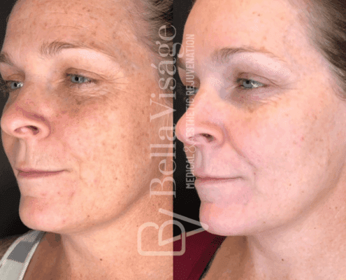 perfect-derma-peel-even-skin-tone-brightening-lakeland-fl-min