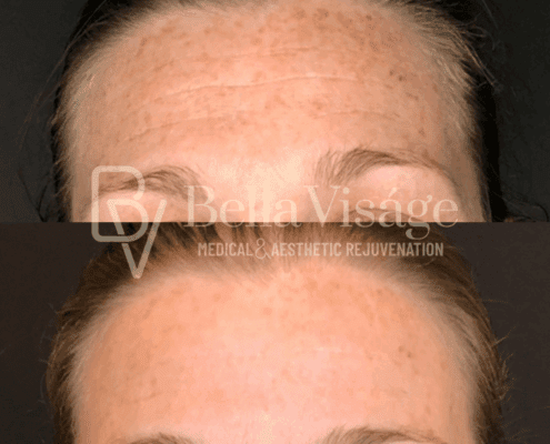 perfect-derma-peel-freckle-reduction-results-lakeland-fl-min