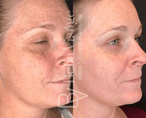 perfect-derma-peel-freckles-sun-damage-before-after-lakeland-fl-min