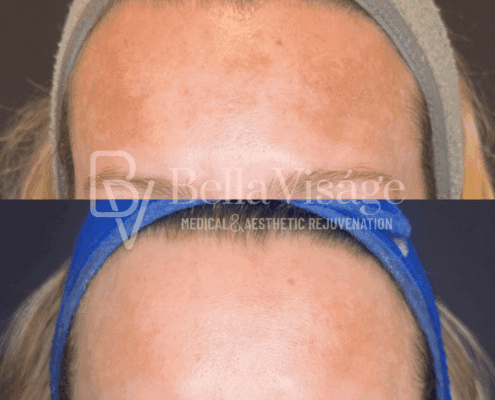 perfect-derma-peel-hyperpigmentation-improvement-lakeland-fl-min