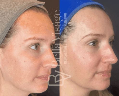 perfect-derma-peel-melasma-before-after-lakeland-fl-min