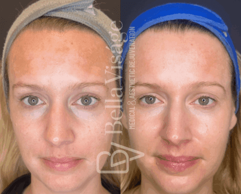 perfect-derma-peel-melasma-treatment-results-lakeland-fl-min