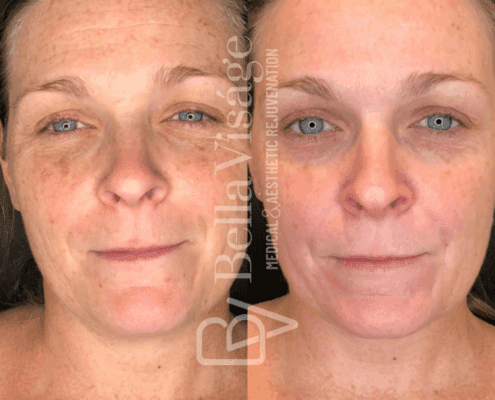 perfect-derma-peel-sun-damage-pigmentation-improvement-lakeland-fl-min