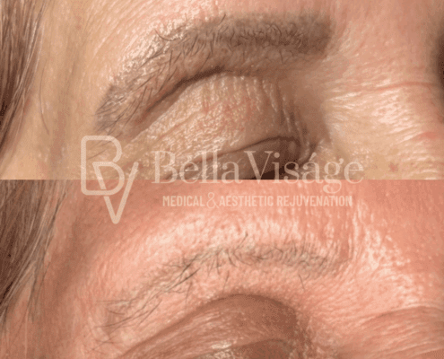laser-microblading-eyebrow-removal-results-lakeland-fl (1)