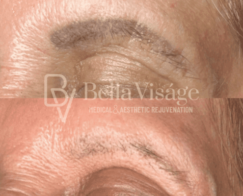 microblading-removal-before-after-lakeland-fl (1)