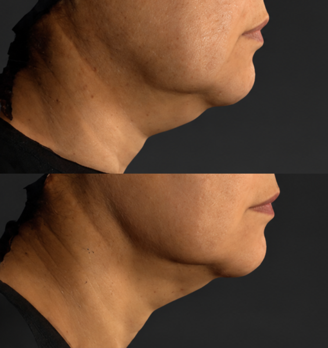 Before & After